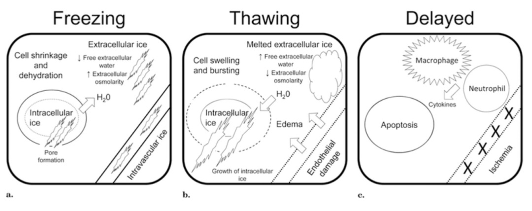 腫瘤治療界的「高冷之花」——腫瘤微創(chuàng)冷凍消融，國(guó)產(chǎn)替代設(shè)備空間巨大